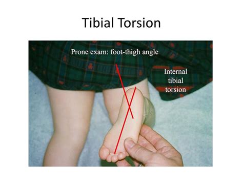 testing for tibial torsion|femoral anteversion and tibial torsion.